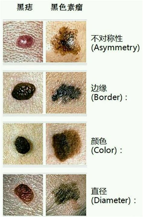 痣中痣|哪些痣会癌变？脸上的痣能点吗？专家这回终于说清楚了